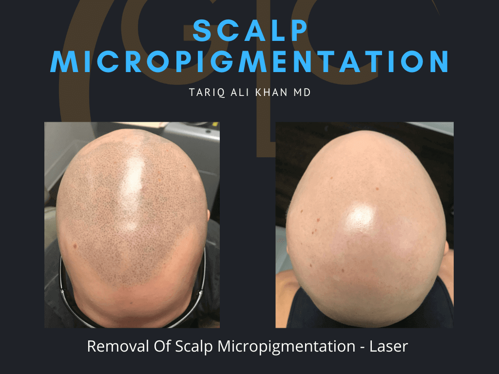 Gentle Care Laser Tustin & Long Beach Before and After picture - Scalp micropigmentation